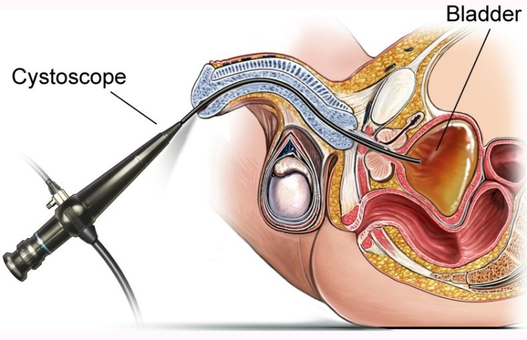 The Rise of Endourology a Minimal Invasive Procedure in Urological Surgeries; & Things Patients Need to Understand