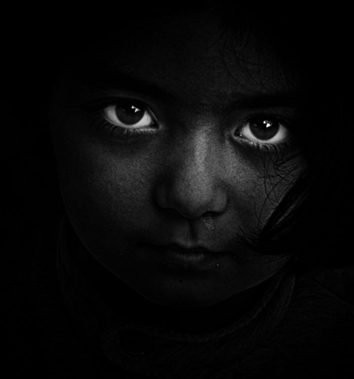 Vision Preserved: Fortis Escorts Hospital Jaipur Performs First Ophthalmic Artery Chemosurgery to Treat Rare Eye Cancer in 2-Year-Old